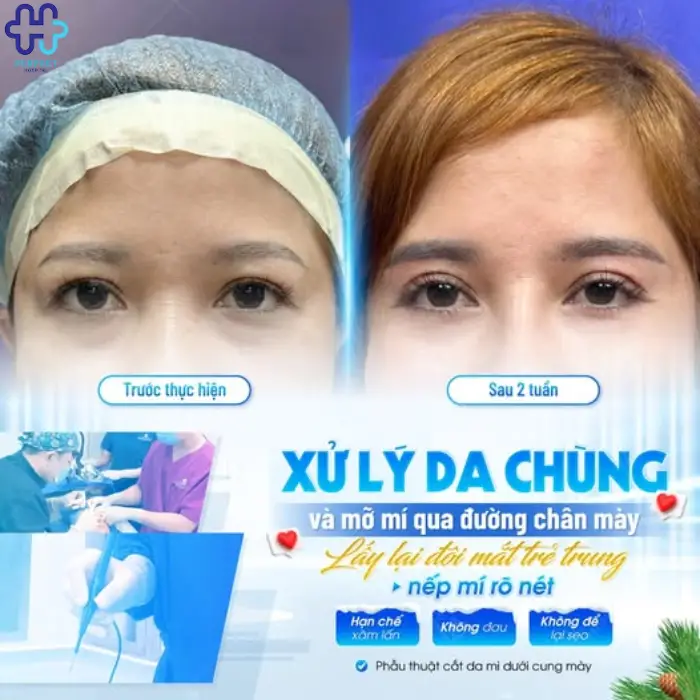 Nâng cung chân mày là gì? Nâng chân mày có tốt không?