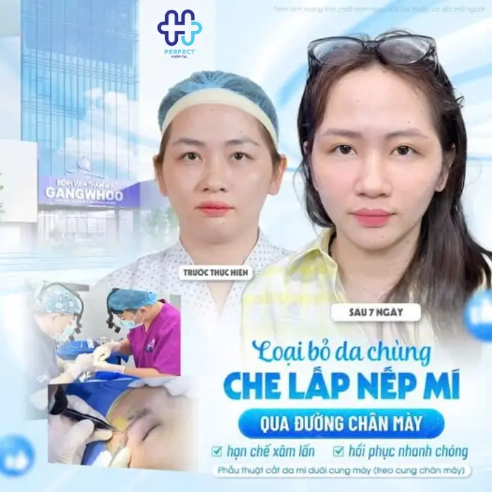 Nâng cung chân mày là gì? Nâng chân mày có tốt không?