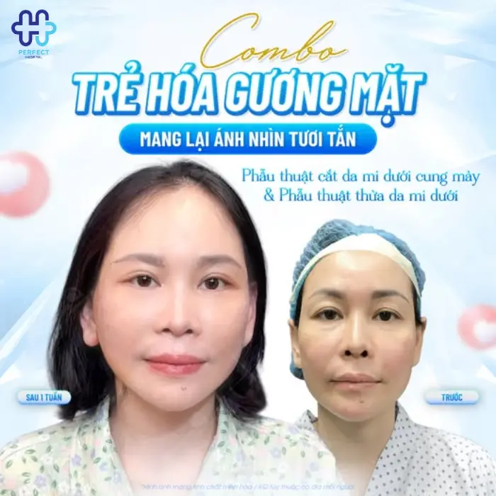 Nâng cung chân mày là gì? Nâng chân mày có tốt không?