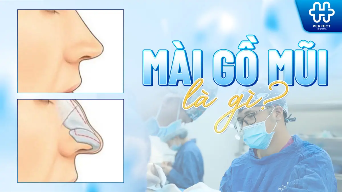 Thế nào là phẫu thuật mài gồ mũi