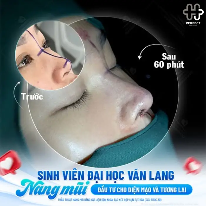 Nâng mũi cấu trúc: Ưu điểm và những lợi ích nổi bật