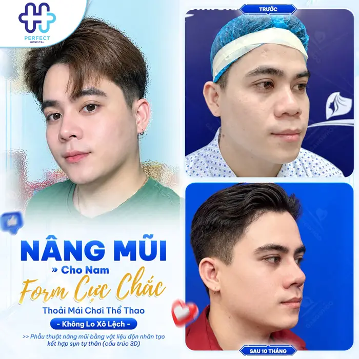 Nâng mũi cấu trúc: Ưu điểm và những lợi ích nổi bật