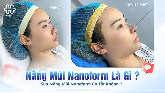 Nâng mũi nanoform là gì? Sụn nâng mũi nanoform có tốt không?