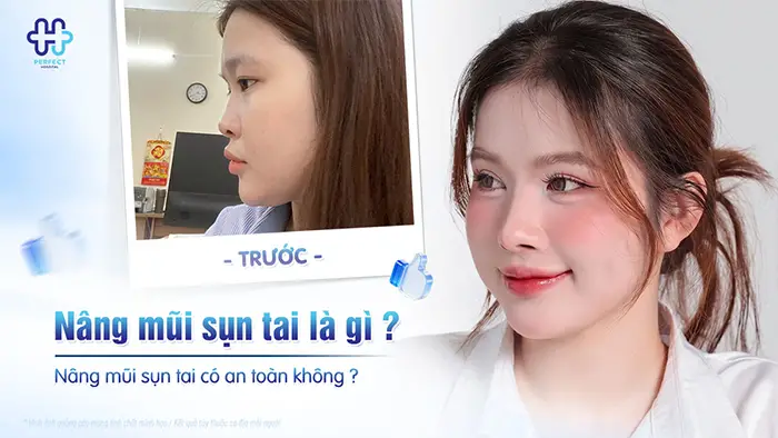 Nâng mũi sụn tai là gì? Nâng mũi sụn tai có an toàn không?