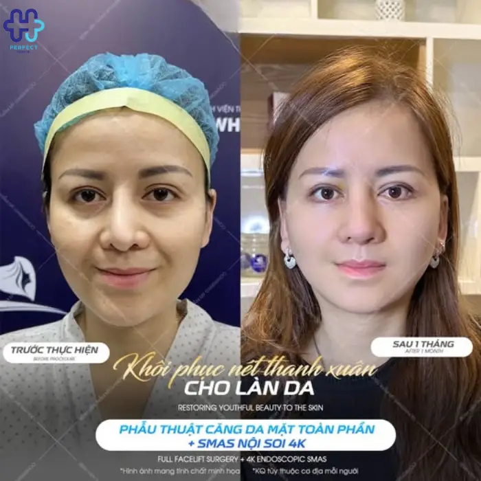 Căng da mặt SMAS là gì? Quy trình thực hiện và lưu ý cần biết