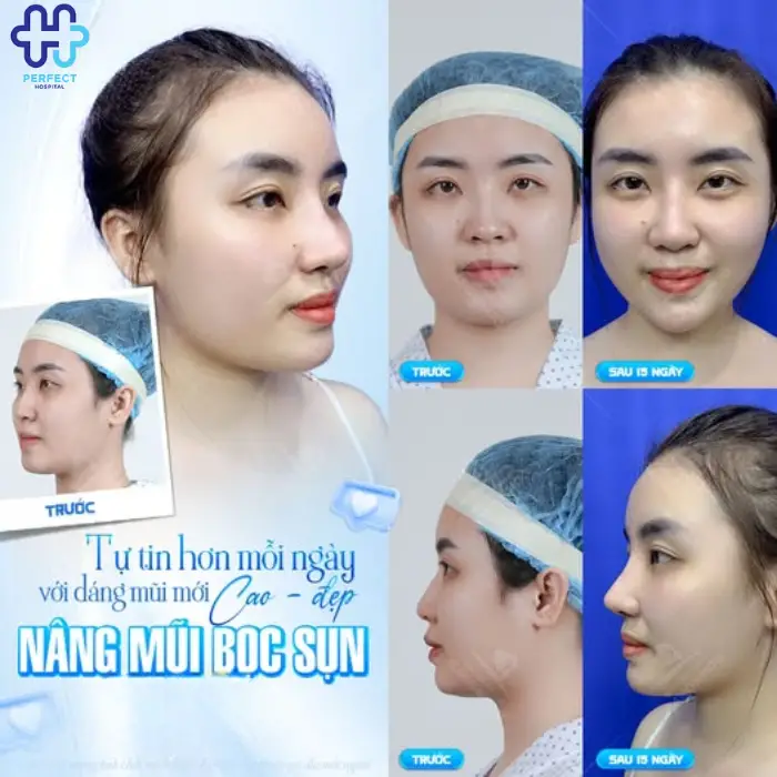 Nâng mũi bọc sụn là gì? Nâng mũi bọc sụn có tốt không?