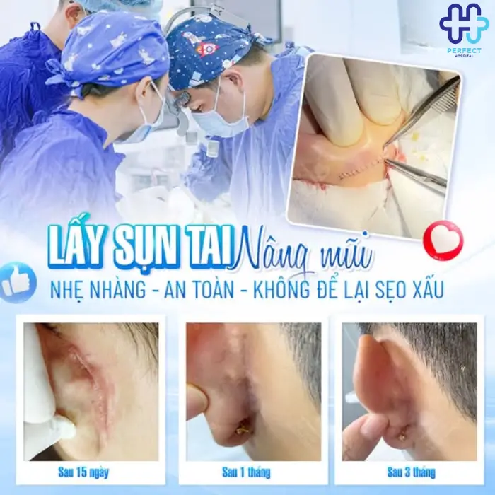 Nâng mũi bọc sụn là gì? Nâng mũi bọc sụn có tốt không?