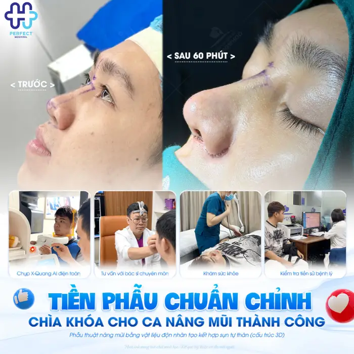 Nâng mũi bọc sụn là gì? Nâng mũi bọc sụn có tốt không?