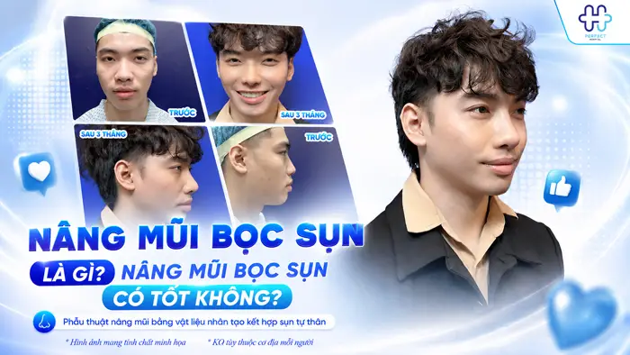 Nâng mũi bọc sụn là gì? Nâng mũi bọc sụn có tốt không?