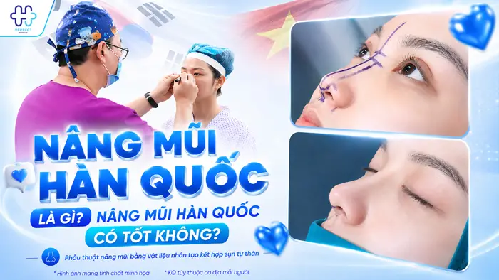 Nâng mũi Hàn Quốc là gì? Nâng mũi Hàn Quốc có tốt không?