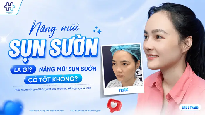 Nâng mũi sụn sườn là gì? Nâng mũi sụn sườn có tốt không?