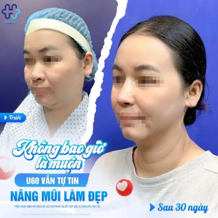 Nâng mũi sụn tai là gì? Nâng mũi sụn tai có an toàn không?