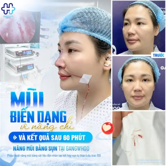 Nâng mũi sụn tai là gì? Nâng mũi sụn tai có an toàn không?