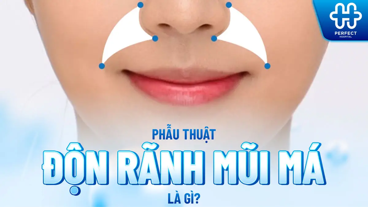 Độn rãnh mũi má và những ưu điểm nổi bật