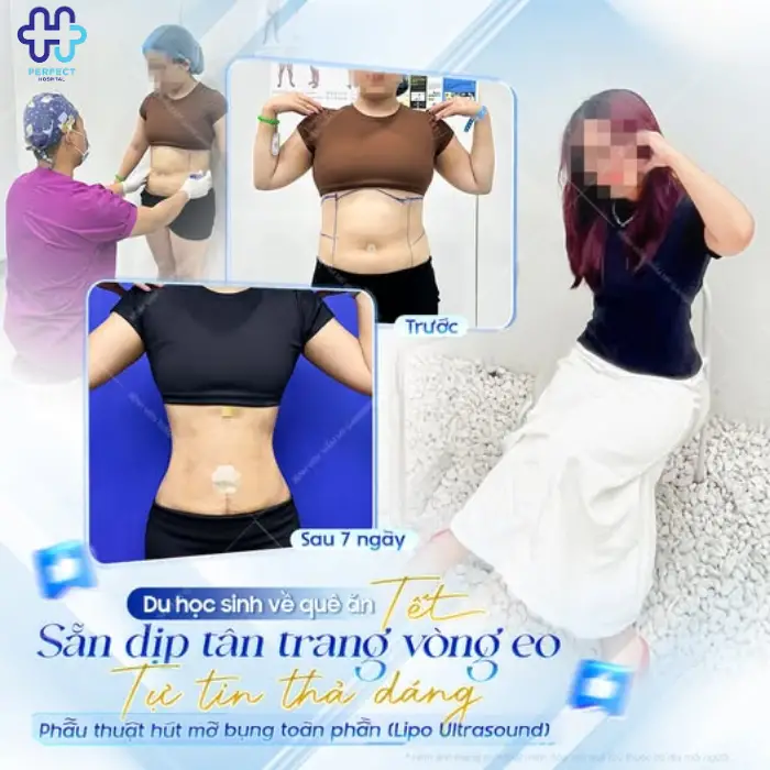 Hút mỡ bắp tay: Chi phí và quy trình thực hiện chi tiết