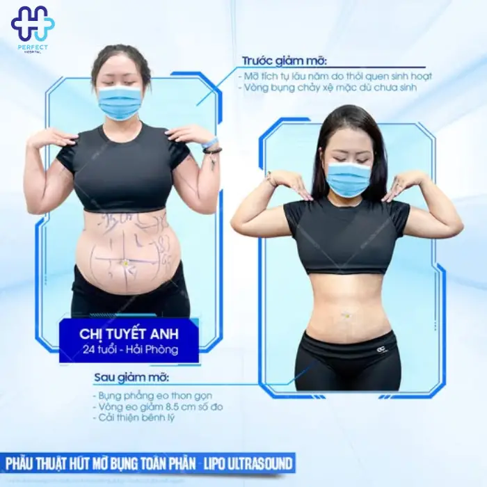 Hút mỡ bắp tay: Chi phí và quy trình thực hiện chi tiết