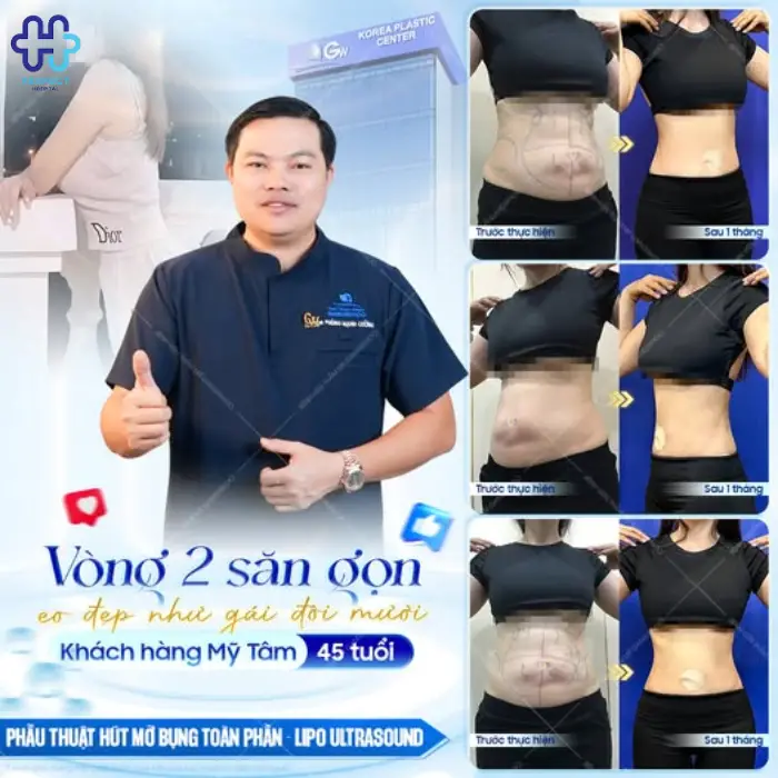 Hút mỡ bắp tay: Chi phí và quy trình thực hiện chi tiết