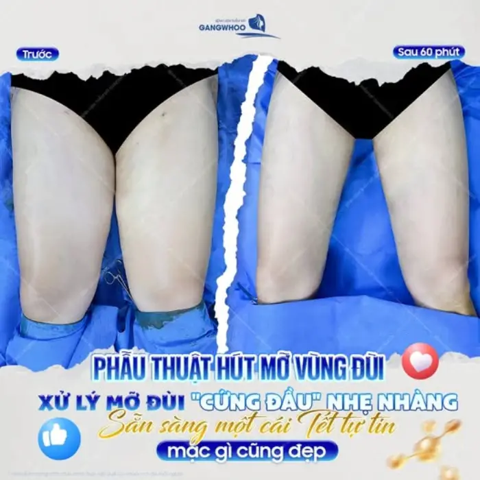 Hút mỡ đùi là gì? Lợi ích của phẫu thuật hút mỡ đùi