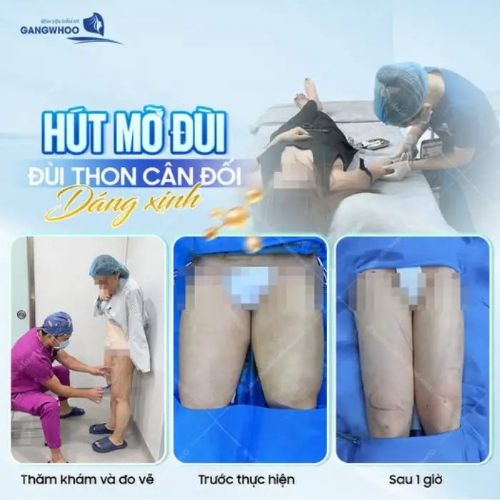 Hút mỡ đùi là gì? Lợi ích của phẫu thuật hút mỡ đùi