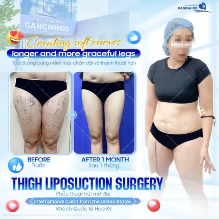 Hút mỡ đùi là gì? Lợi ích của phẫu thuật hút mỡ đùi
