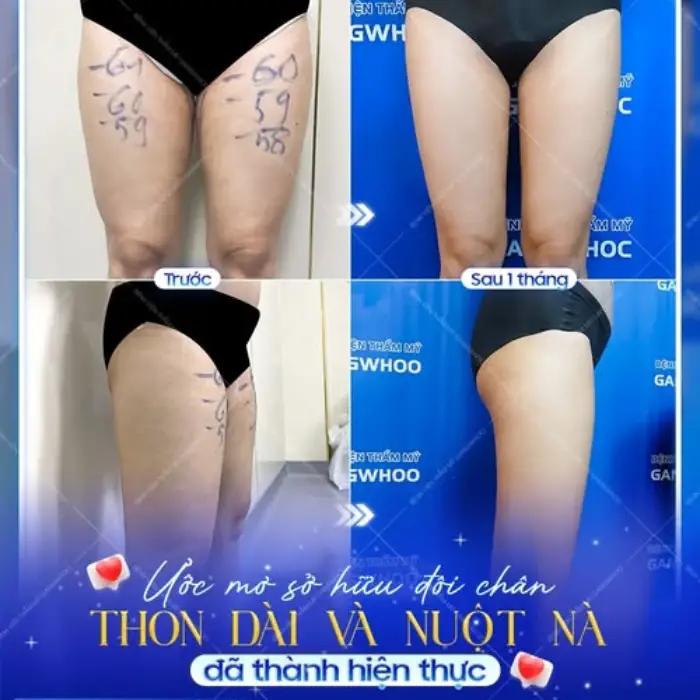 Hút mỡ đùi là gì? Lợi ích của phẫu thuật hút mỡ đùi