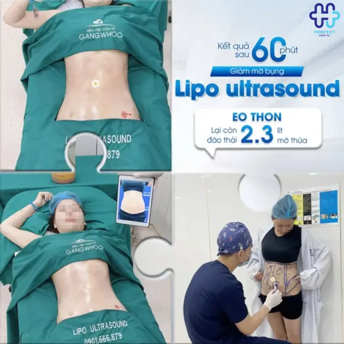 Hút mỡ eo, hông là gì? Những điều bạn cần biết