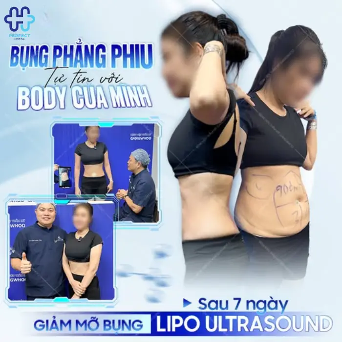 Hút mỡ eo, hông là gì? Những điều bạn cần biết