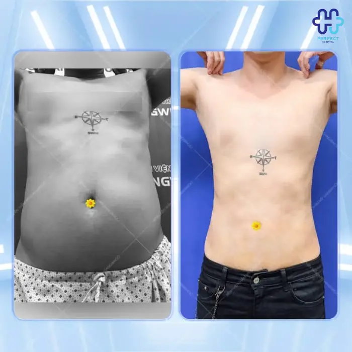 Hút mỡ lưng: Chi phí thực hiện và quy trình chuẩn từng bước