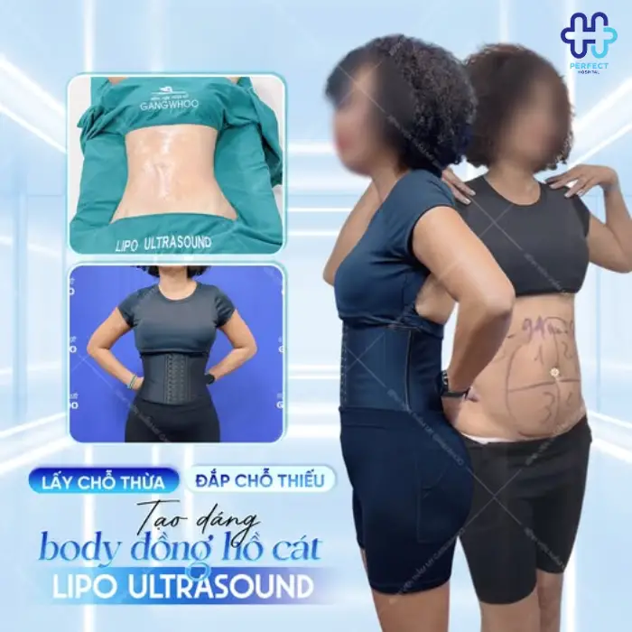 Hút mỡ lưng: Chi phí thực hiện và quy trình chuẩn từng bước