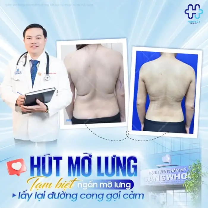 Hút mỡ lưng: Chi phí thực hiện và quy trình chuẩn từng bước
