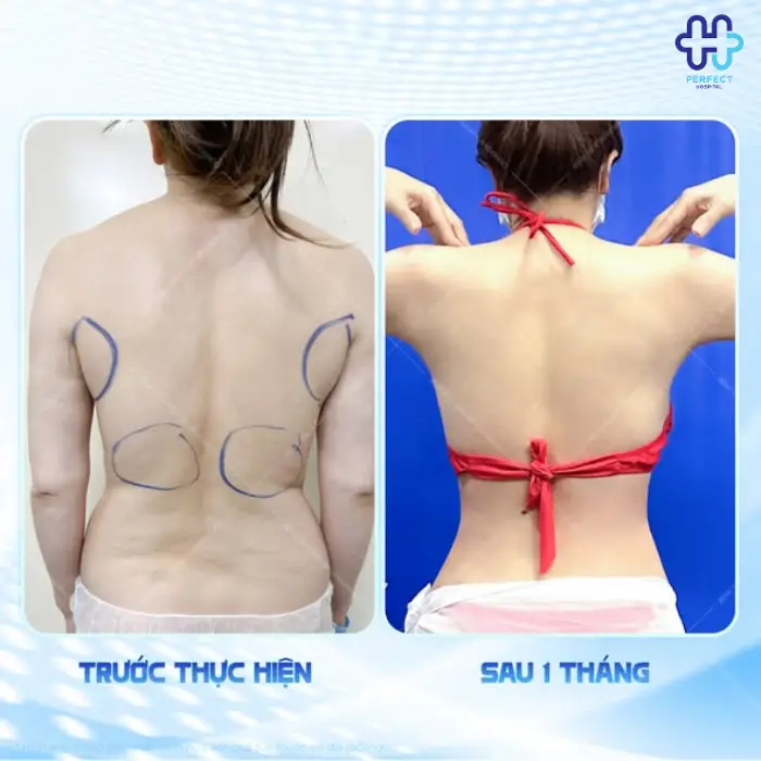 Hút mỡ lưng: Chi phí thực hiện và quy trình chuẩn từng bước