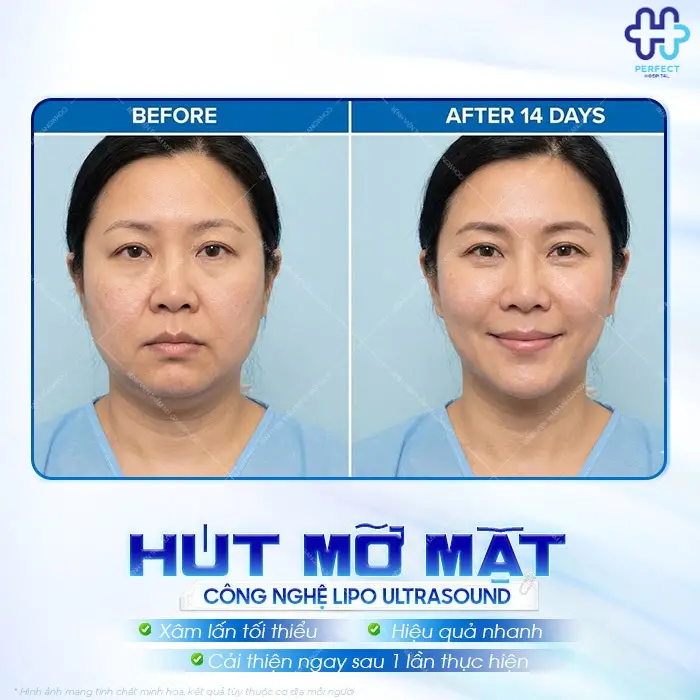 Hút mỡ mặt là gì? Có nên hút mỡ mặt không?