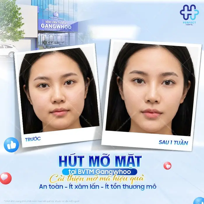 Hút mỡ mặt là gì? Có nên hút mỡ mặt không?