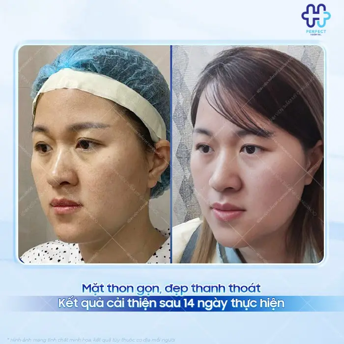 Hút mỡ mặt là gì? Có nên hút mỡ mặt không?