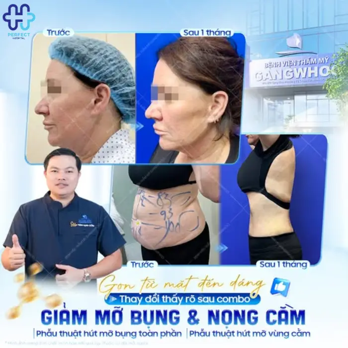 Hút mỡ mặt là gì? Có nên hút mỡ mặt không?