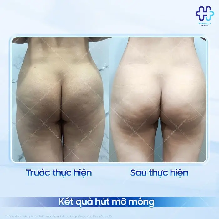 Hút mỡ mông là gì? Hút mỡ mông có an toàn không?