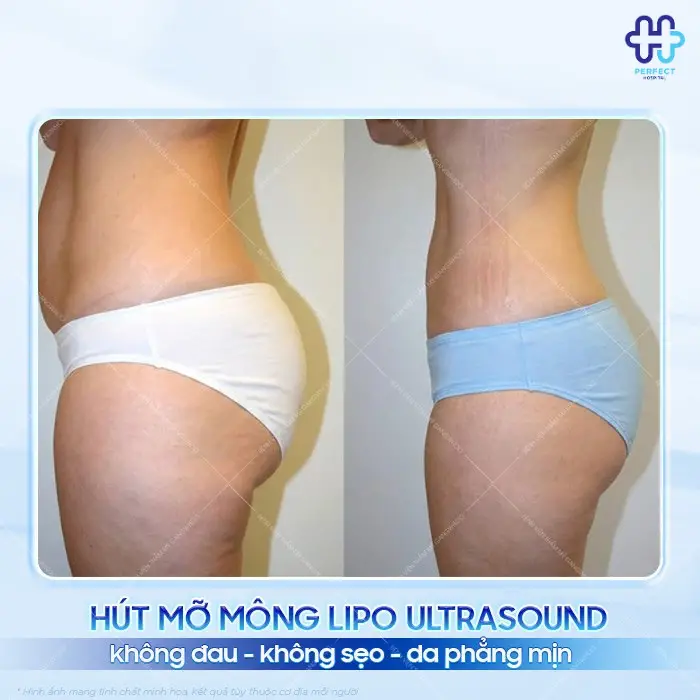 Hút mỡ mông là gì? Hút mỡ mông có an toàn không?