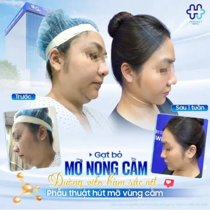 Hút mỡ nọng cằm là gì? Có nên hút mỡ vùng cằm không?