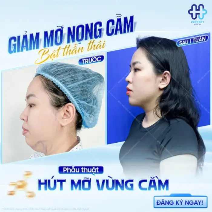 Hút mỡ nọng cằm là gì? Có nên hút mỡ vùng cằm không?