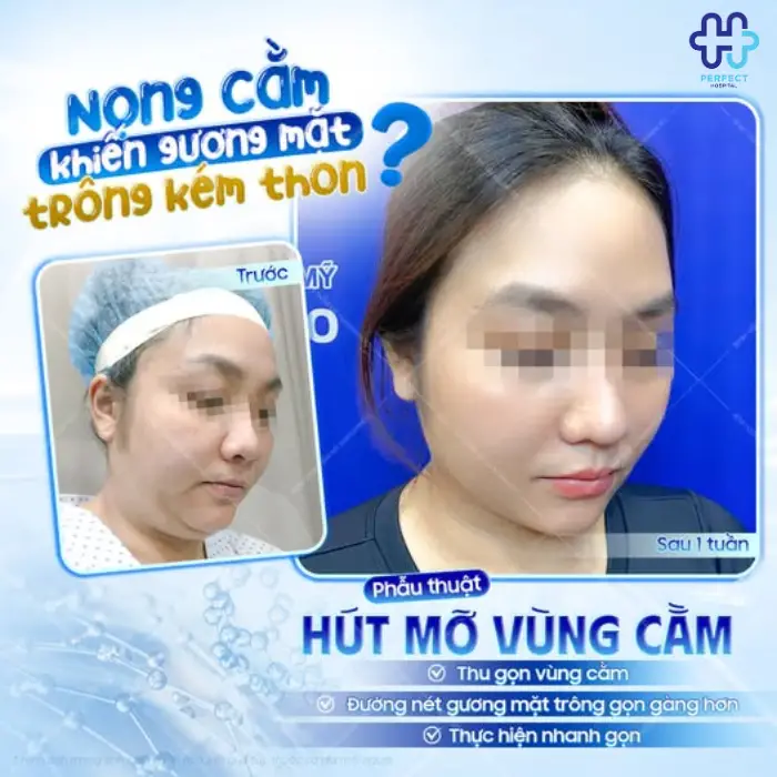 Hút mỡ nọng cằm là gì? Có nên hút mỡ vùng cằm không?