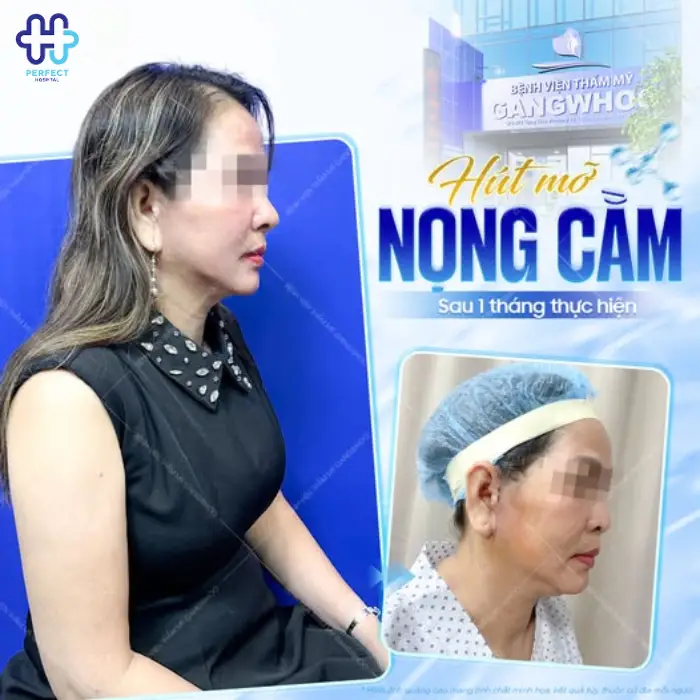 Hút mỡ nọng cằm là gì? Có nên hút mỡ vùng cằm không?