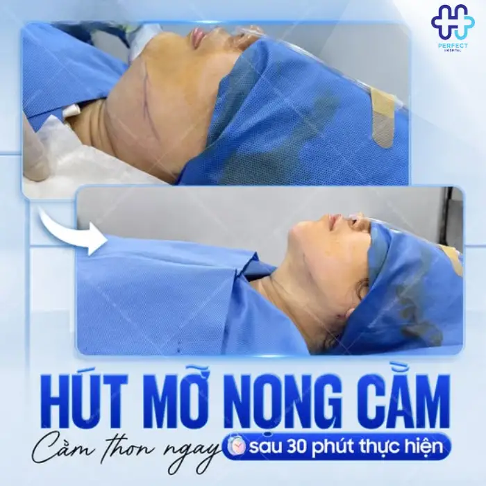 Hút mỡ nọng cằm là gì? Có nên hút mỡ vùng cằm không?
