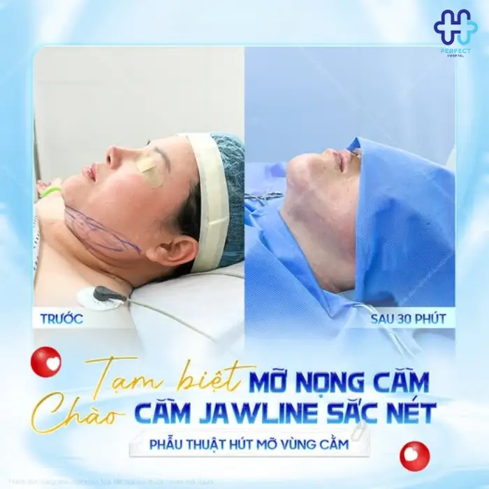 Hút mỡ nọng cằm là gì? Có nên hút mỡ vùng cằm không?