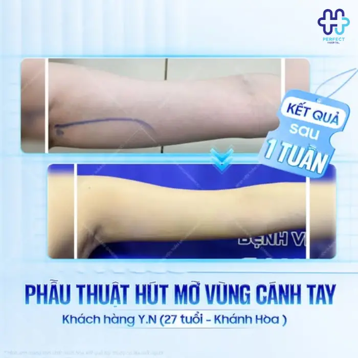 Hút mỡ vai là gì? Ưu điểm của phẫu thuật hút mỡ vai