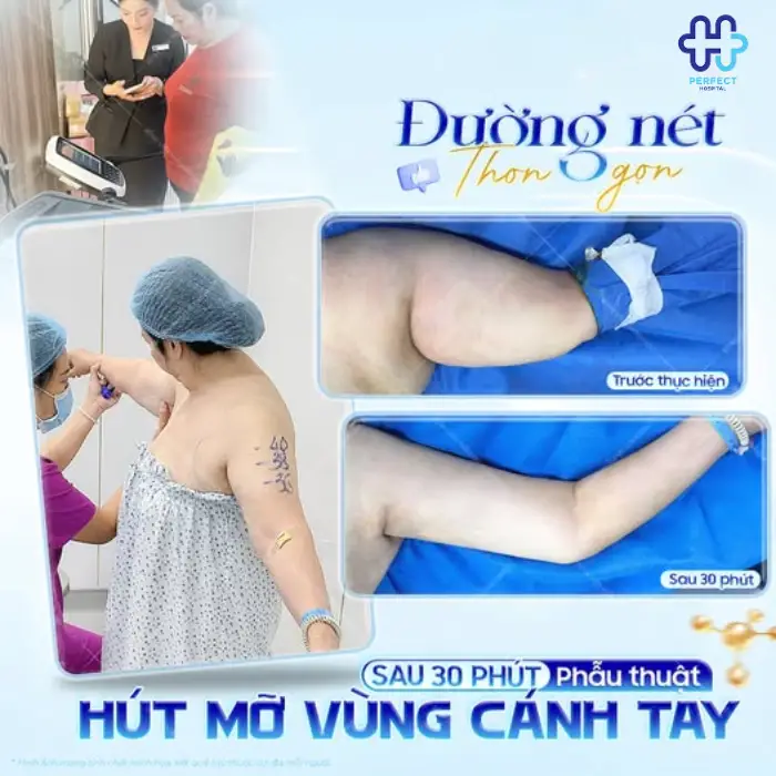 Hút mỡ vai là gì? Ưu điểm của phẫu thuật hút mỡ vai