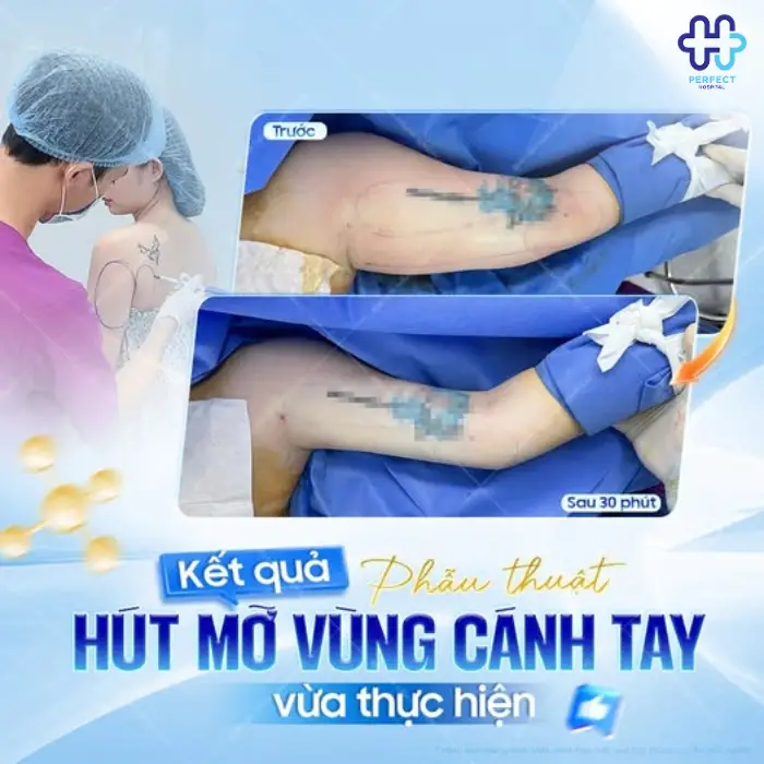 Hút mỡ vai là gì? Ưu điểm của phẫu thuật hút mỡ vai