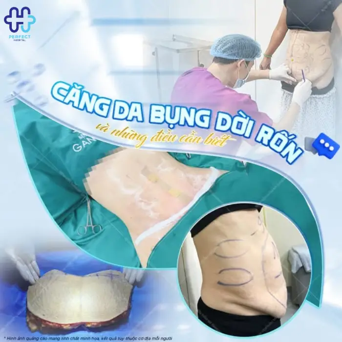 Căng da bụng là gì? Căng da vùng bụng có an toàn không?