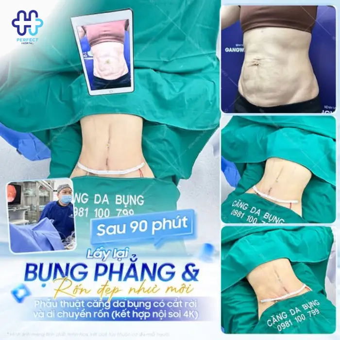 Căng da bụng là gì? Căng da vùng bụng có an toàn không?