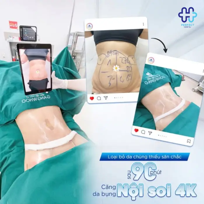 Căng da bụng là gì? Căng da vùng bụng có an toàn không?