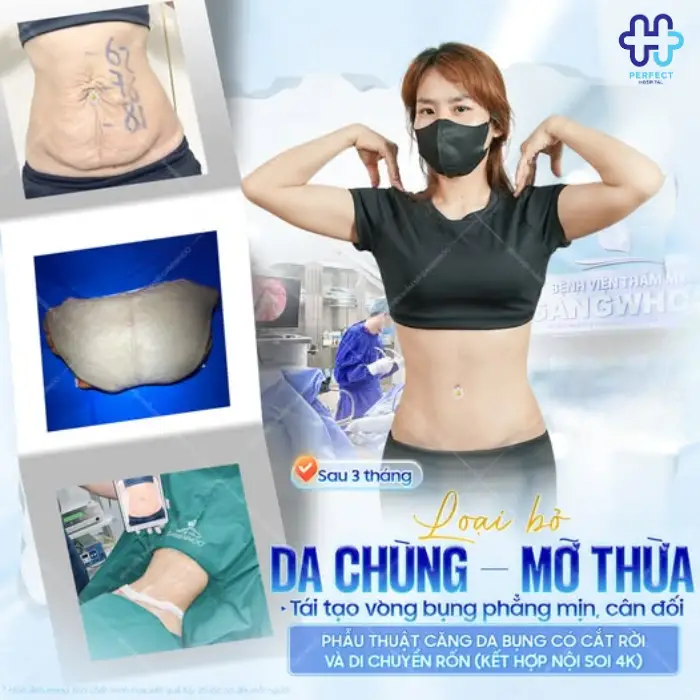 Căng da bụng là gì? Căng da vùng bụng có an toàn không?